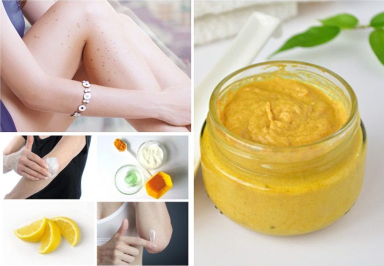 6 Natural Ways to Remove Dark Spots from Arms and Legs